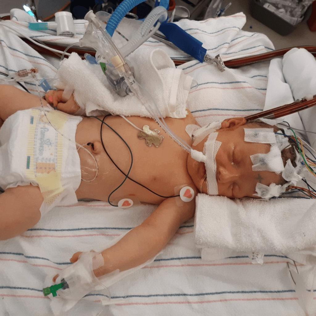 Congenital Diaphragmatic Hernia Research
