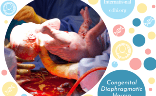 Research: Placental fetal vascular malperfusion in congenital diaphragmatic hernia