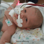 Newborn baby in a hospital bed with a breathing tube and medical adhesive on the face, connected to monitoring wires on a patterned blanket.